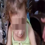 إحالة الأم المتهمة بتعذيب طفلتها الصغرى بـ"الكى" بمنيا القمح للجنايات