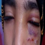 إصابة تلميذة بتورم وكدمات فى العين نتيجة إهمال مدرسة فى الزقازيق