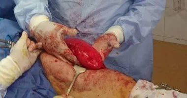 أطباء كليه طب الزقازيق ينجحون فى استئصال ورم وزنه 1.5 كيلو من قدم مريضة