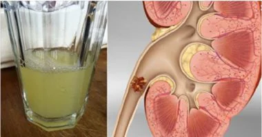 تعرف على المشروب الصحى القادر على التخلص من أغلب مشاكل الكلى