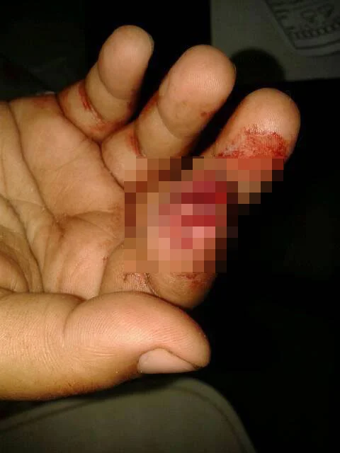 سيدة تقطع "عقلة" إصبع جارتها بأسنانها بسبب لهو الأطفال فى أبو كبير