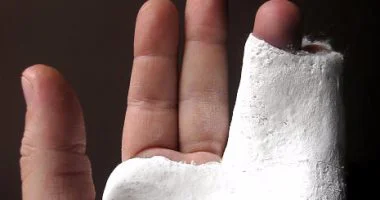 قبل الجبس.. 10 طرق منزلية بسيطة للتعامل مع الكسور