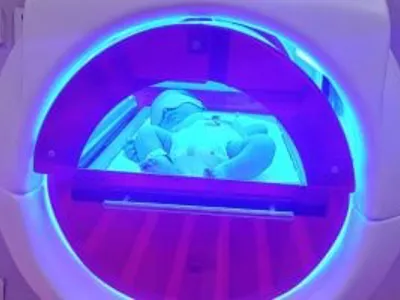 الكبسولة الضوئية تستقبل أول رضيع مصاب بالصفراء بمستشفى العاشر من رمضان الجامعى